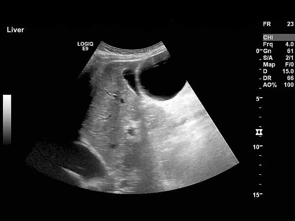 Polycystic liver disease, ultrasound scan C017  /  8021