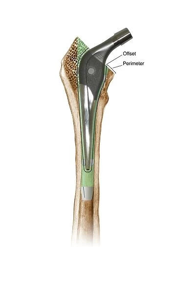 Prosthetic hip joint, diagram C016  /  6775
