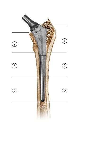 Prosthetic hip joint and Gruen zones C016  /  6779