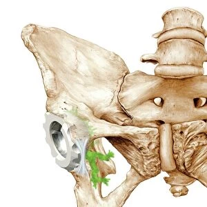 Hip replacement, artwork