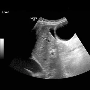 Polycystic liver disease, ultrasound scan C017 / 8021