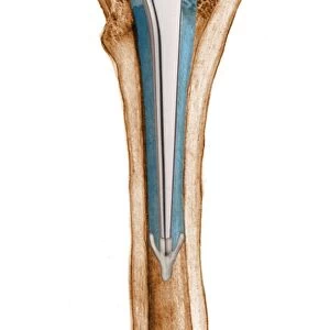 Prosthetic hip joint, artwork C016 / 6782