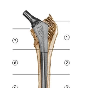 Prosthetic hip joint and Gruen zones C016 / 6779