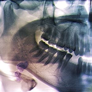 Salivary gland stone, X-ray