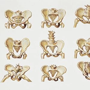 Illustration of human pelvis, examples of damaged hips